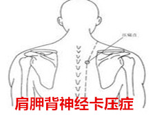 肩胛背神经卡压症