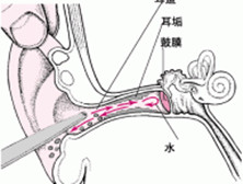 弥漫性外耳道炎