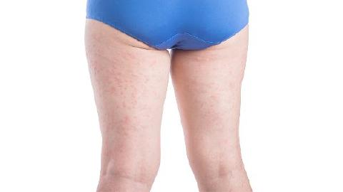 大腿内侧瘙痒越抓越痒怎么回事