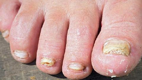 灰指甲怎么治疗才能彻底断根