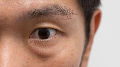 割眼袋后凹陷做自体脂肪填充需要多少钱呢