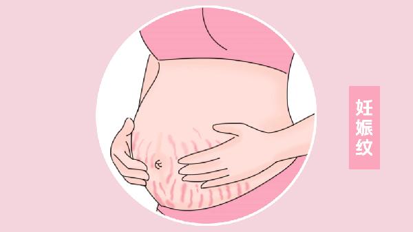 做光子去妊娠纹手术多少钱？