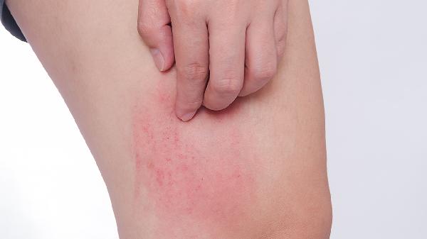 腹型紫癜怎么治疗?腹型过敏性紫癜症状