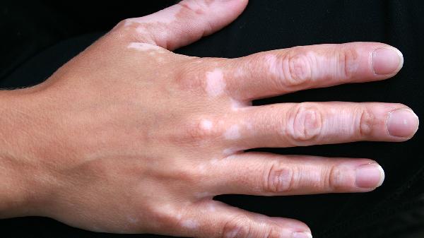 白化病人的痛苦 白化病人怕什么