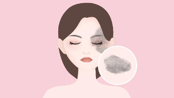 太田痣如何确诊 详述太田痣的几个确诊方法
