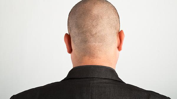 男人肾虚会掉头发吗 掉头发是因为肾虚吗